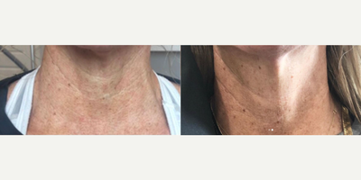 Microneedling before and after photo