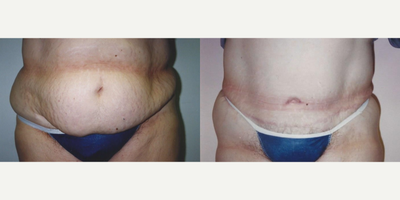 Tummy Tuck before and after photo
