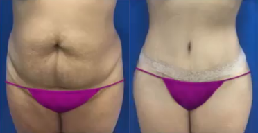Tummy Tuck before and after photo