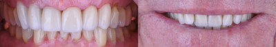 Dental Crown before and after photo