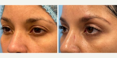Eyelid Surgery before and after photo