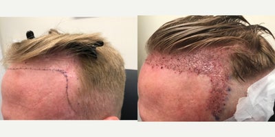 FUE Hair Transplant before and after photo
