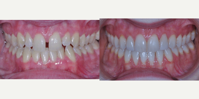 Lingual Braces before and after photo