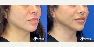Liposuction before and after photo