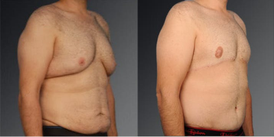 Tummy Tuck before and after photo
