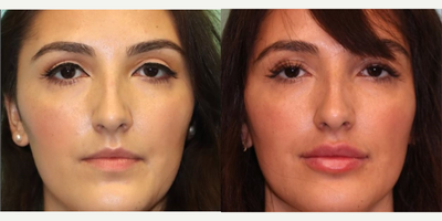Lip Fillers before and after photo