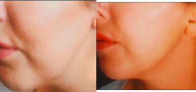Restylane Lyft before and after photo