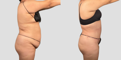Tummy Tuck before and after photo