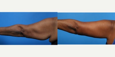 Arm Lift before and after photo