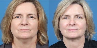 Chin Liposuction before and after photo