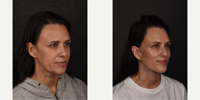 Eyelid Surgery before and after photo