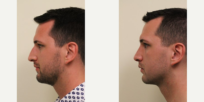 Rhinoplasty before and after photo