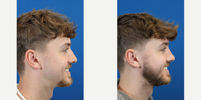 Rhinoplasty before and after photo