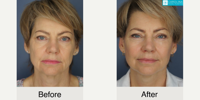 Buccal Fat Removal before and after photo