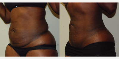 BodyTite before and after photo