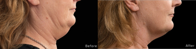 CoolSculpting before and after photo