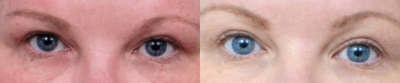 Eyelid Surgery before and after photo