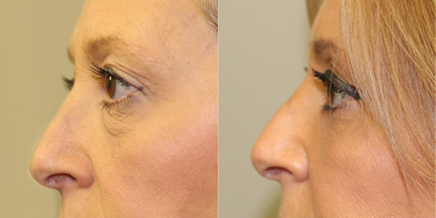 Eyelid Surgery before and after photo