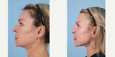Eyelid Surgery before and after photo
