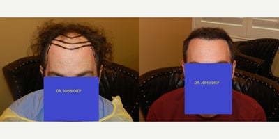 Hair Loss Treatment before and after photo