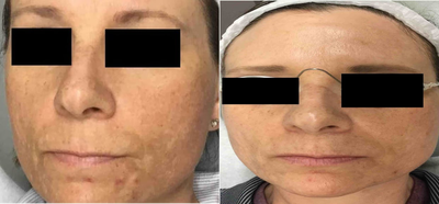 Laser Genesis before and after photo