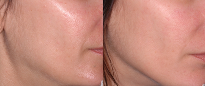 Ultherapy before and after photo