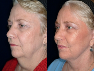 Facelift before and after photo