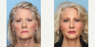 Facelift before and after photo