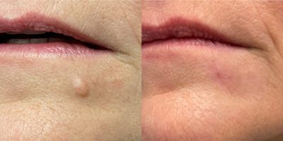 Mole Removal before and after photo