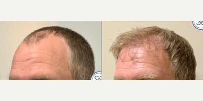 NeoGraft before and after photo