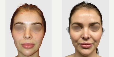 Rhinoplasty before and after photo
