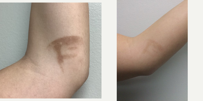 Laser Resurfacing before and after photo
