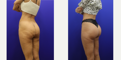 Butt Implants before and after photo