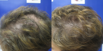 PRP for Hair Loss before and after photo
