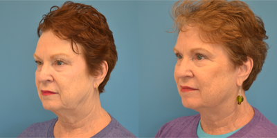 Facelift before and after photo