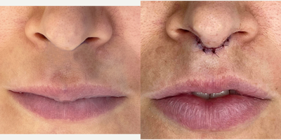 Lip Lift before and after photo