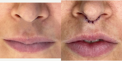 Lip Lift before and after photo