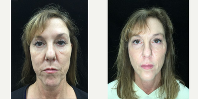 Mini Facelift before and after photo