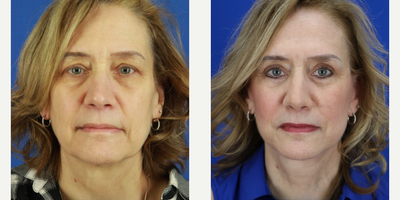Mini Facelift before and after photo