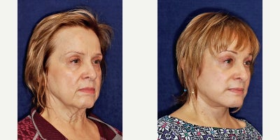 Neck Lift before and after photo