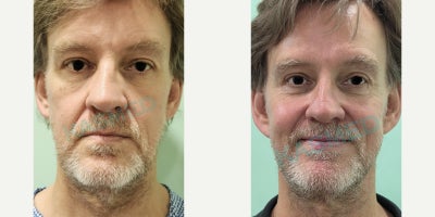 Neck Lift before and after photo