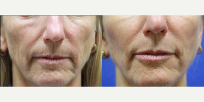 Restylane before and after photo
