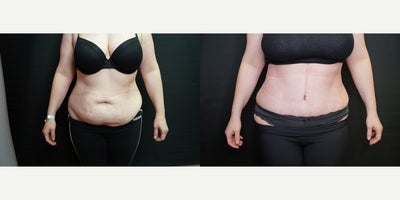 Tummy Tuck before and after photo