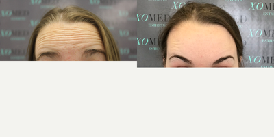 Botox before and after photo