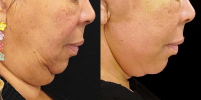 Deep Plane Facelift before and after photo