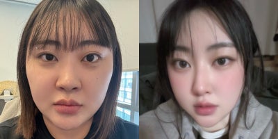 Double Eyelid Surgery before and after photo