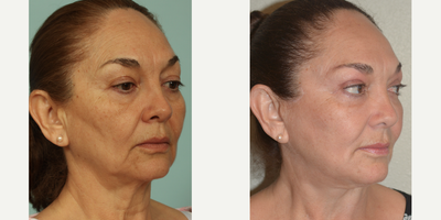 Facelift before and after photo