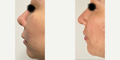 Rhinoplasty before and after photo