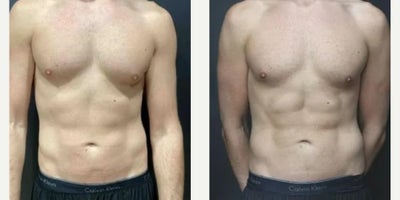 Abdominal Etching before and after photo