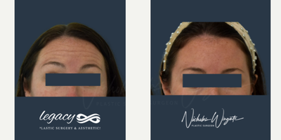 Botox before and after photo